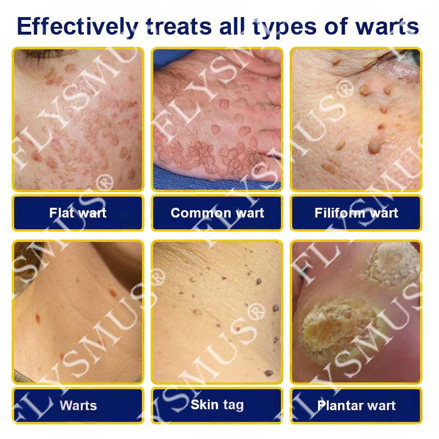 🇨🇦FLYSMUS® SKIN TAG CRYO TREATMENT SPRAY ACE