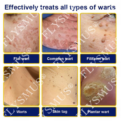 🇨🇦FLYSMUS® SKIN TAG CRYO TREATMENT SPRAY ACE