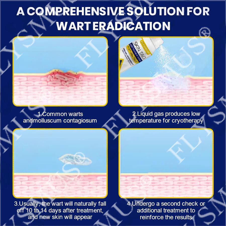 🇨🇦FLYSMUS® SKIN TAG CRYO TREATMENT SPRAY ACE